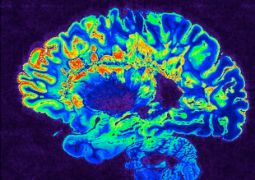 cervello cellule staminali sclerosi